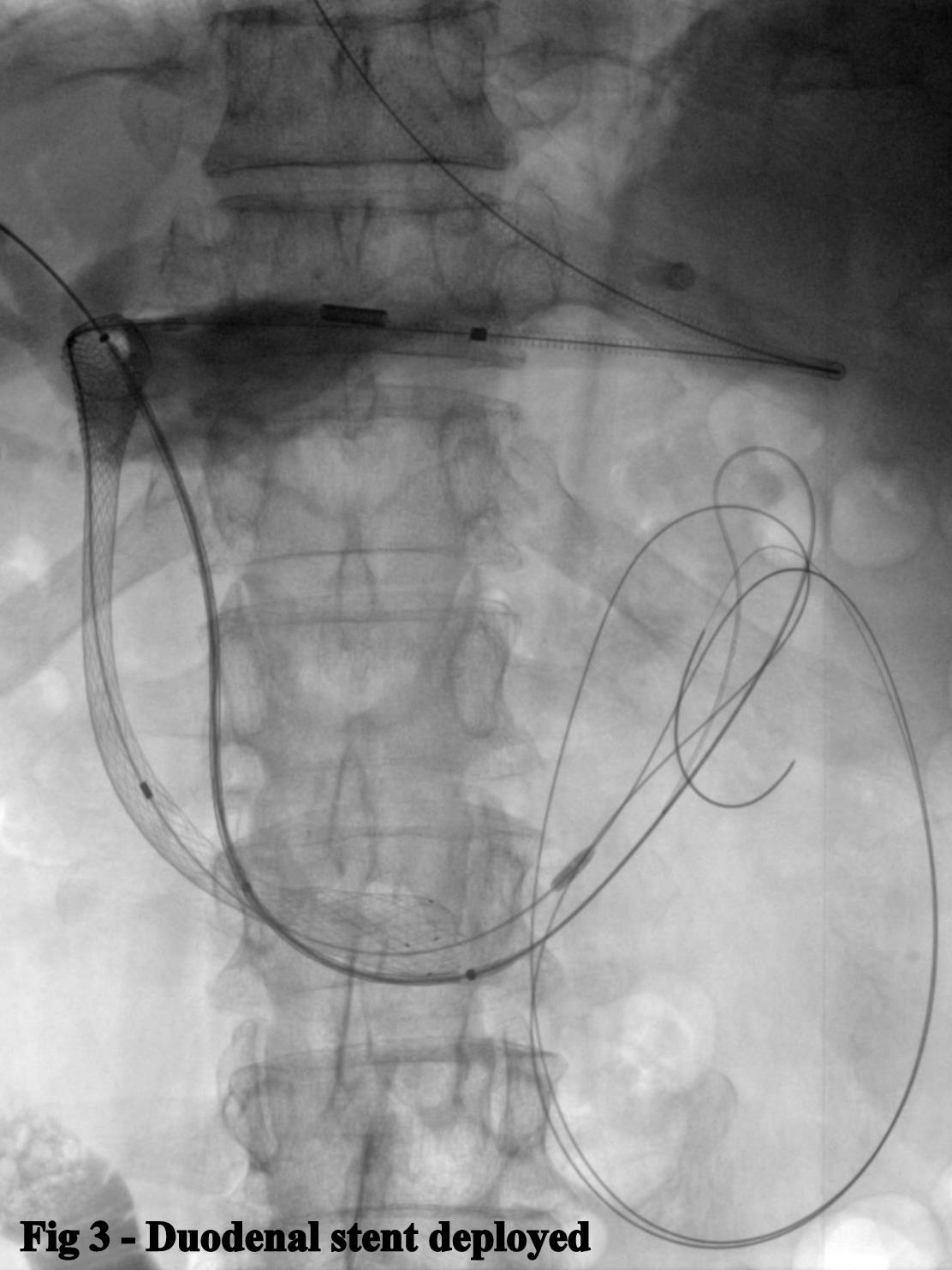 Fig 3. Duodenal stent deployed